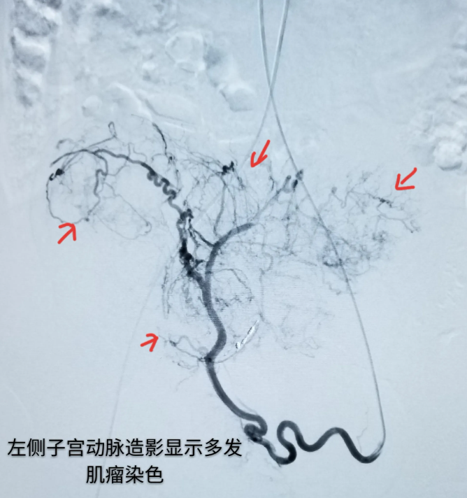 子宫动脉栓塞