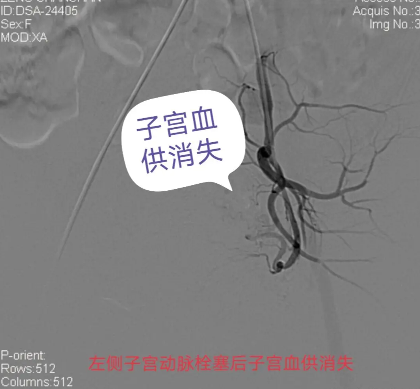 子宫动脉血脉消失