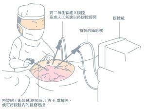 腹腔镜手术