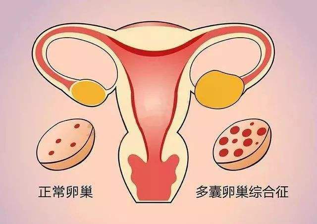 多囊卵巢可以做第三代试管